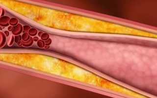 Какой уровень холестерина считается высоким