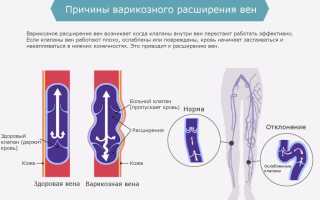 Почему чешутся вены на ногах при варикозе